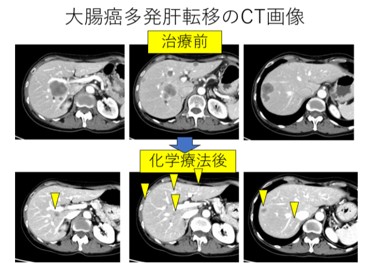 大腸がん多発肝転移