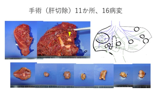 肝切除