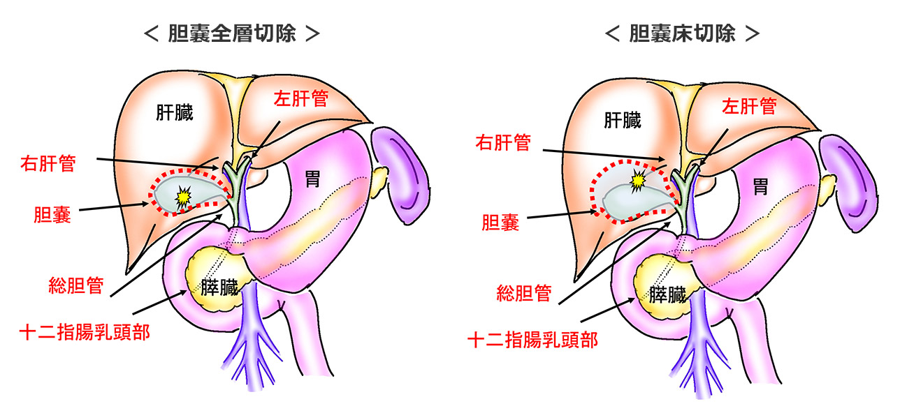 胆嚢がん疑い例に対する腹腔鏡手術