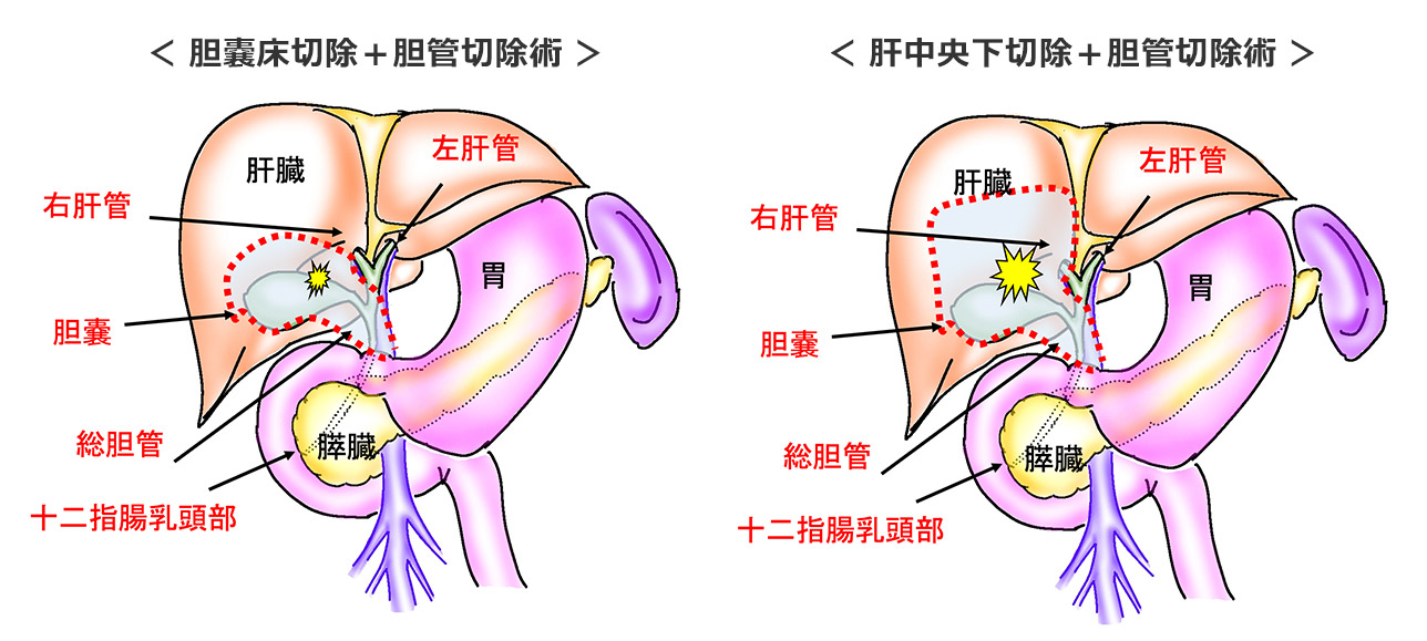 胆嚢床切除術、肝中央下切除術±胆管切除術