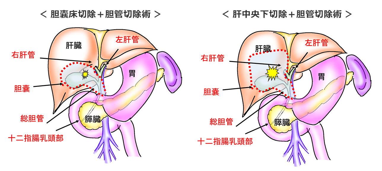 胆管がんの症状はステージごとにどのように進行しますか?