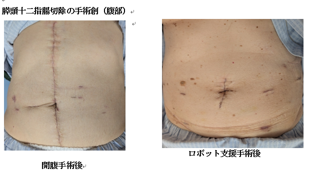 膵頭十二指腸切除の手術創