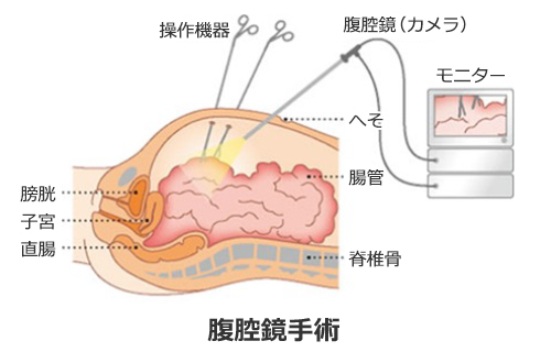 図2：腹腔鏡手術について