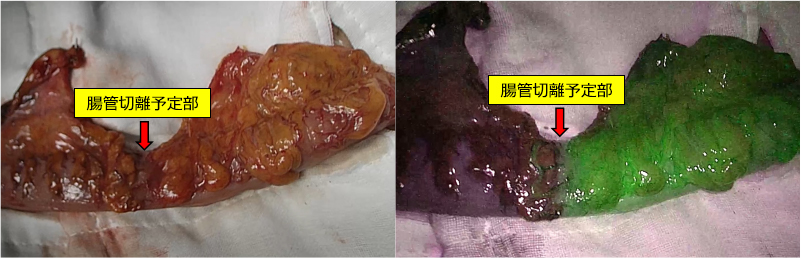 図7：ICGを用いた腸管血流評価