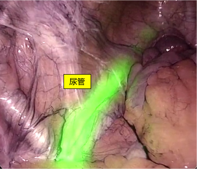 図8：蛍光尿管ステント留置による尿管損傷の予防