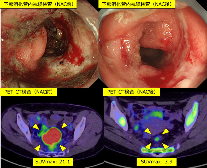 図9：局所進行直腸がんに対するNAC
