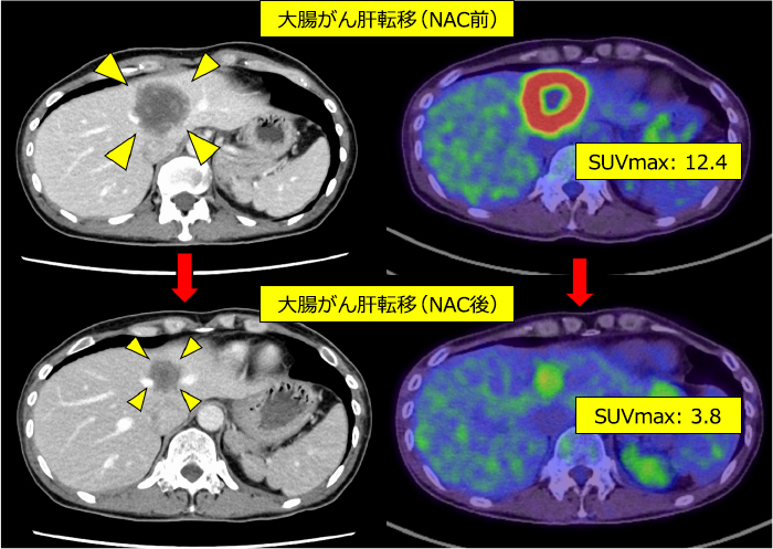 図10：大腸がん肝転移に対する化学療法