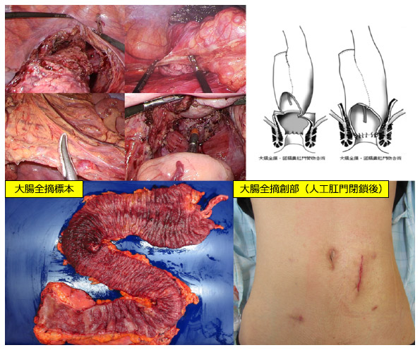 図11：潰瘍性大腸炎の手術