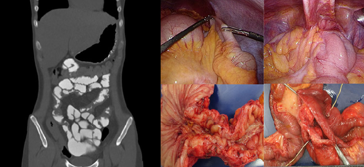 図12：CTエンテログラフィ（左）、クローン病に対する腹腔鏡手術（右）