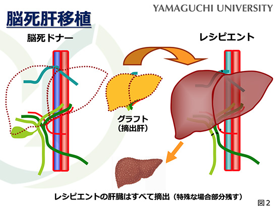 肝移植とは？