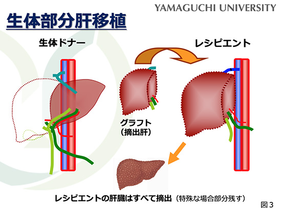 肝移植とは？