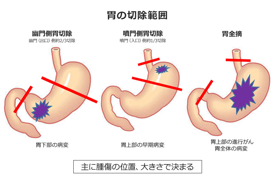 胃の切除範囲
