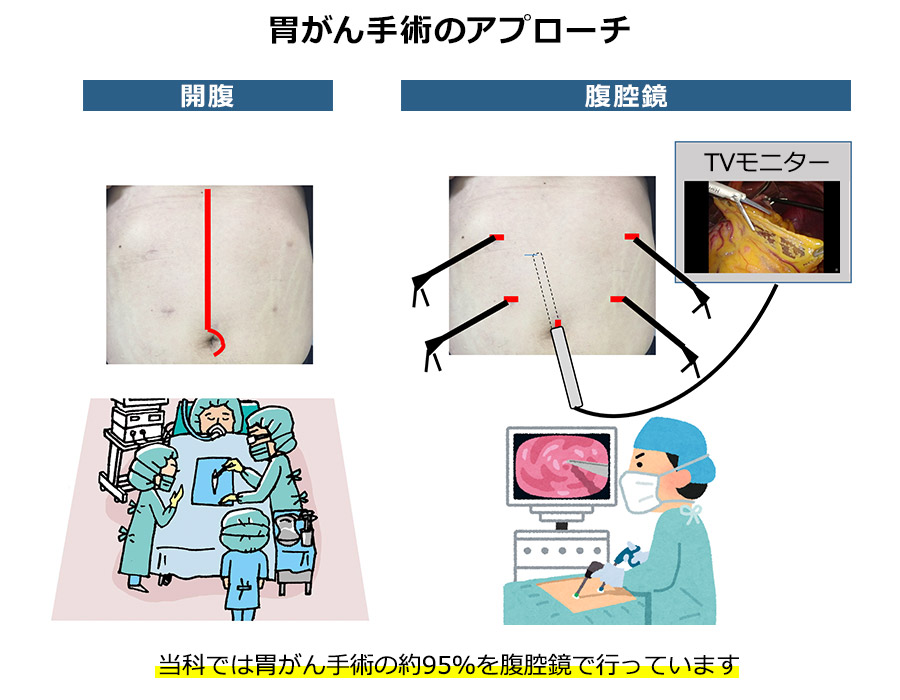 胃がん手術のアプローチ