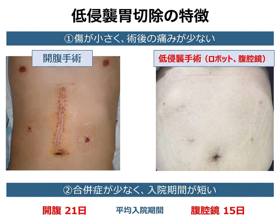 噴門側胃切除術の導入