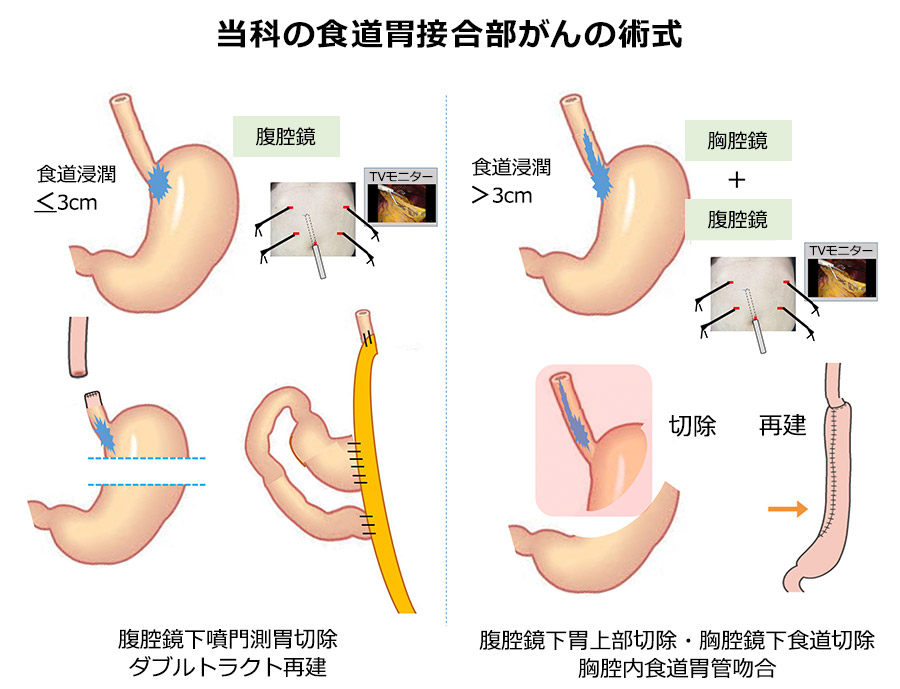 当科の食道胃接合部がんの術式