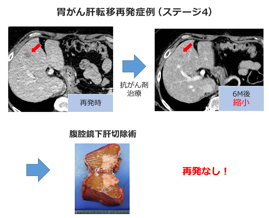 年度別上部消化管手術症例数