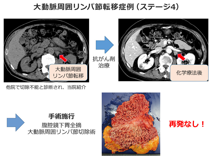 年度別上部消化管手術症例数