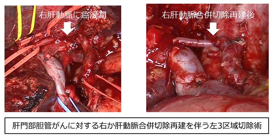 血管再建手技を駆使した拡大手術を積極的に行っています。