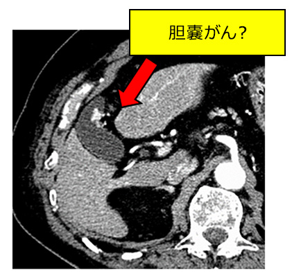 胆嚢がんが疑われる場合に、診断目的の低侵襲手術を行っています。