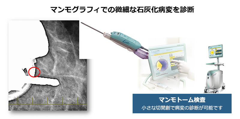 乳がん診断方法の充実