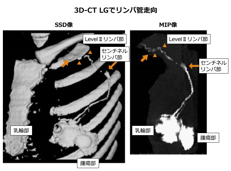 3D CT LGでのリンパ管走向