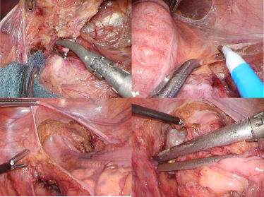 図1：直腸がん手術
