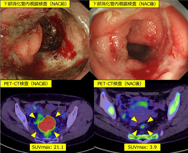 図5：局所進行直腸がんに対するNAC