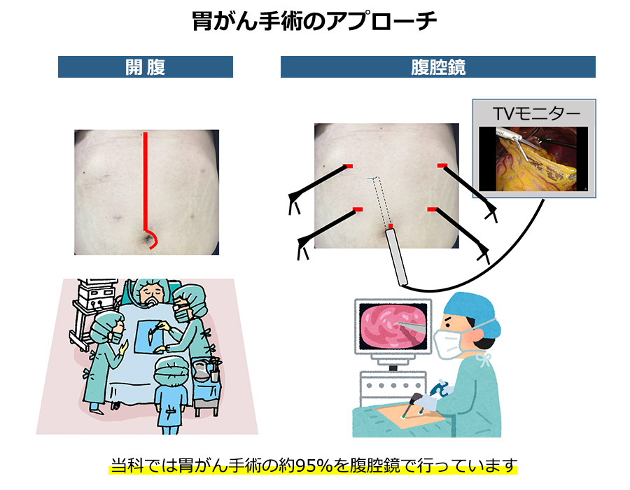 胃がん手術のアプローチ