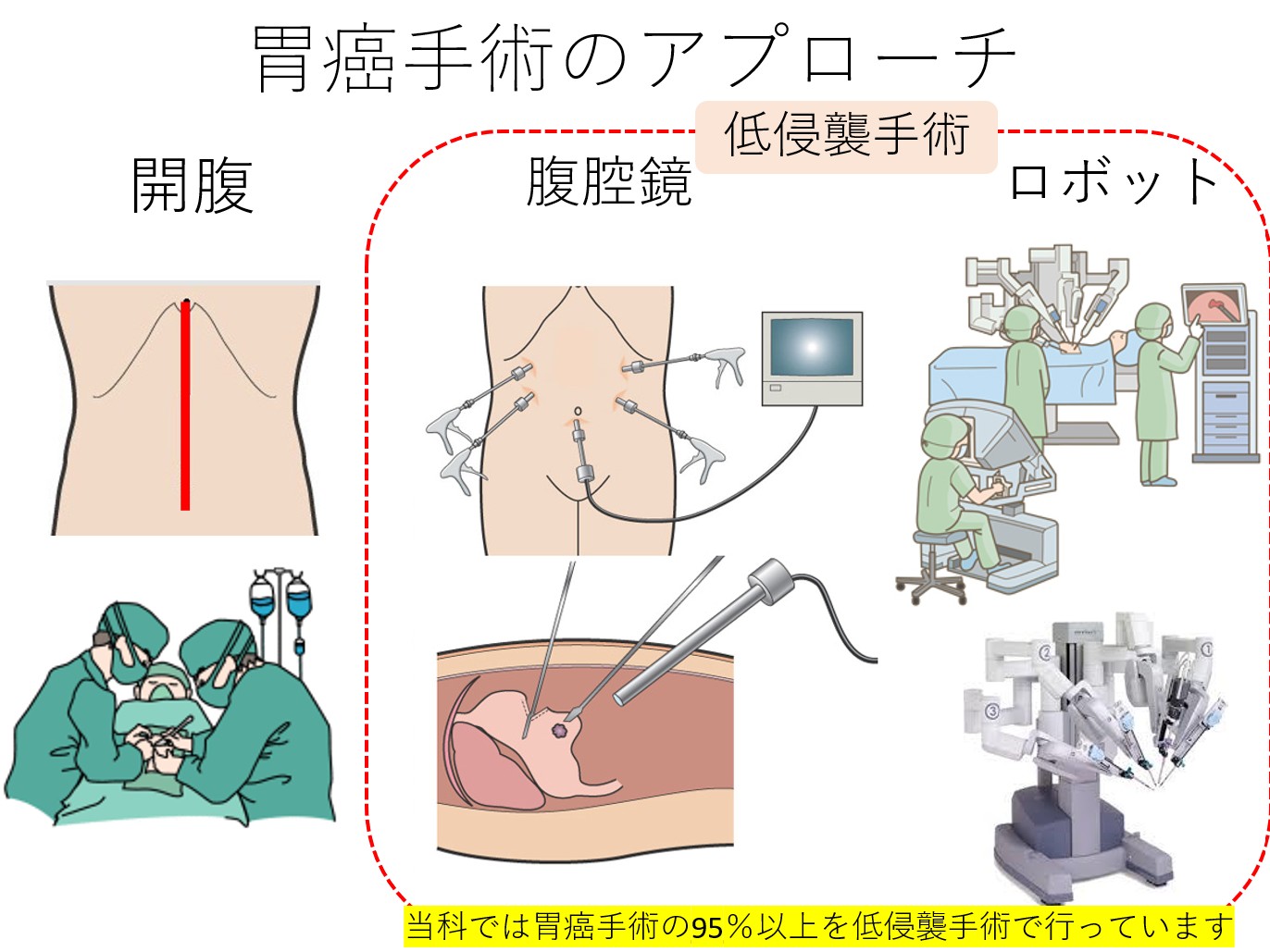 胃癌手術のアプローチ
