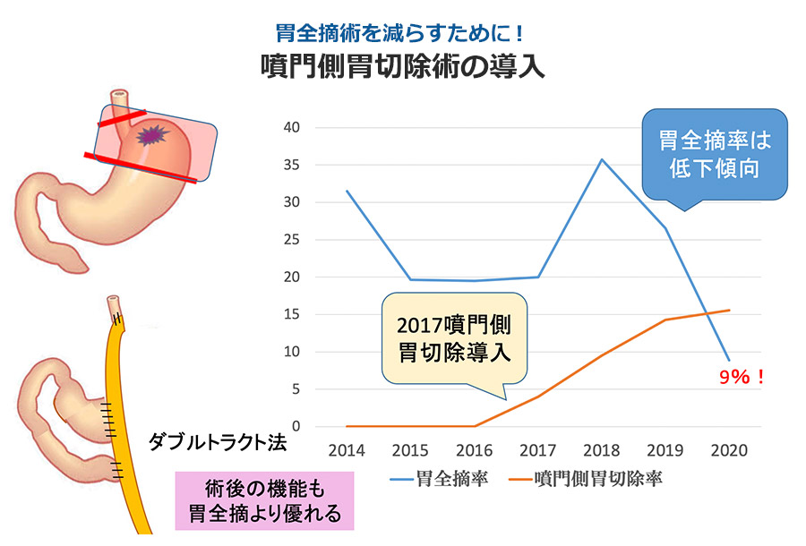 噴門側胃切除術の導入