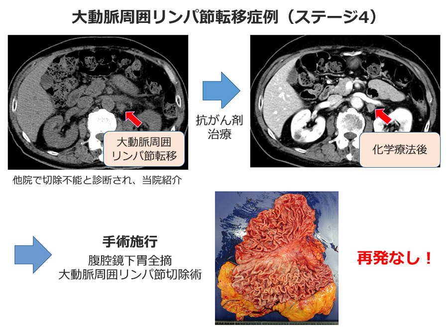 大動脈周囲リンパ節転移症例