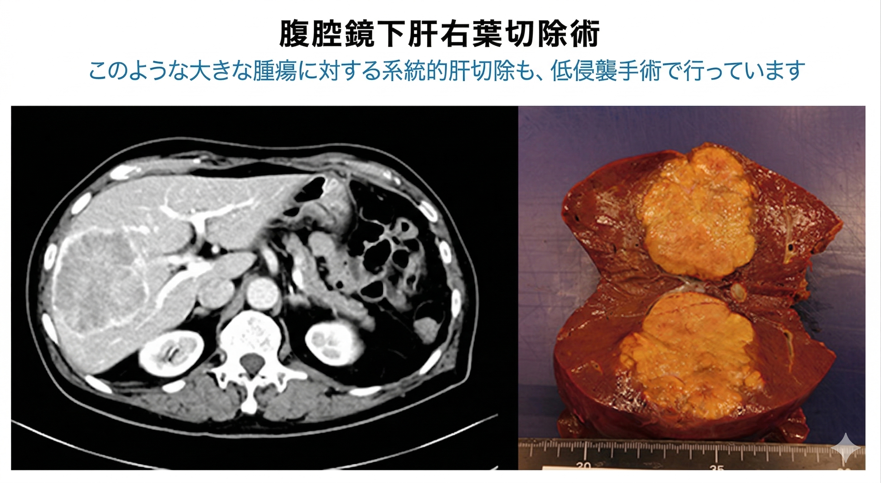 肝がん手術の約7割を腹腔鏡手術で行っています