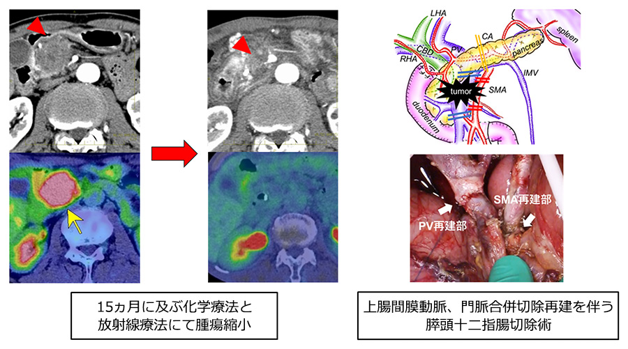 診断時に切除不能と診断された進行膵がんに対しても積極的治療を行っています。