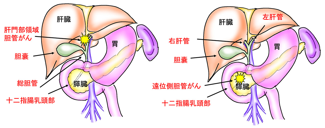 胆管がん