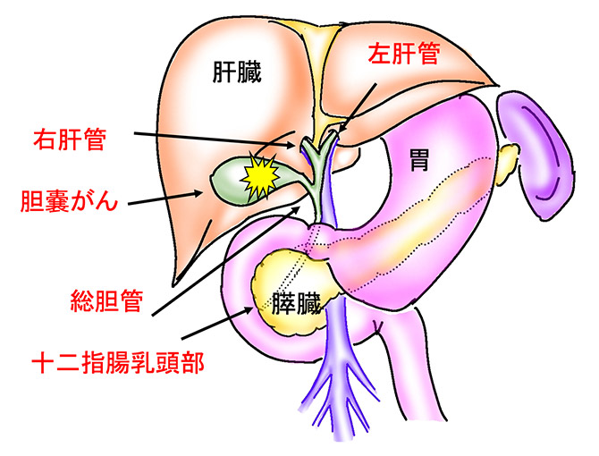 胆嚢がん