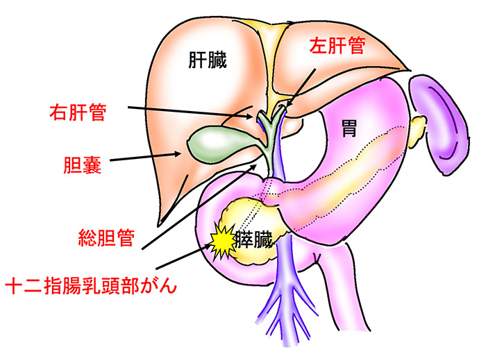 乳頭部がん