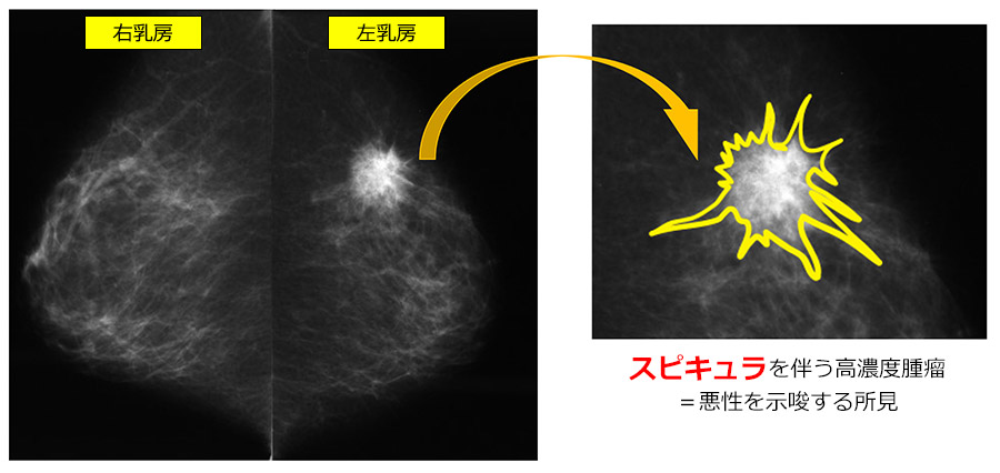 マンモグラフィ：乳がんを疑う腫瘤