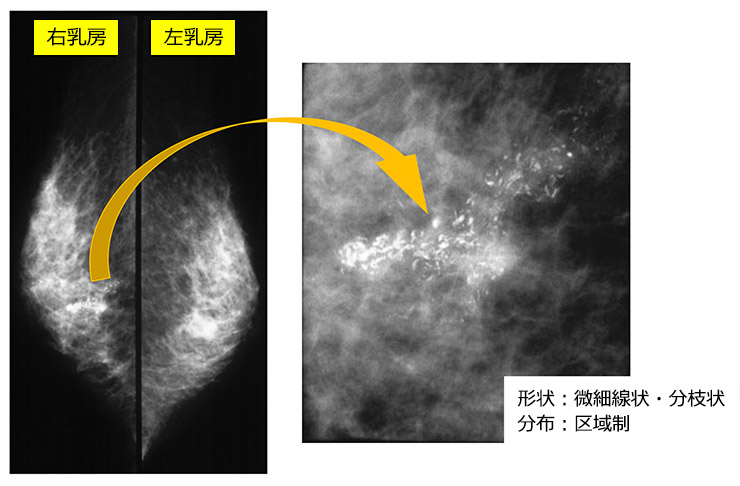 マンモグラフィ：乳がんを疑う石灰化