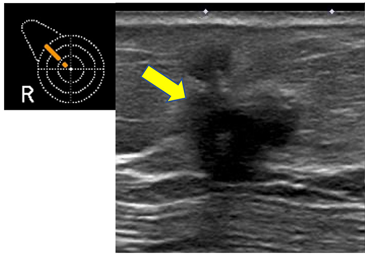 右乳房に11mm大の不整形な乳がんを疑う低エコー腫瘤を認める