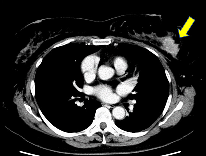 CT検査　左乳がん