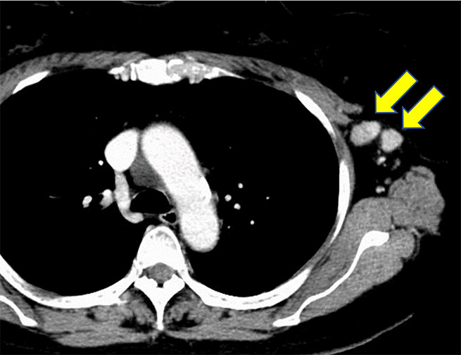 左腋窩リンパ節腫大