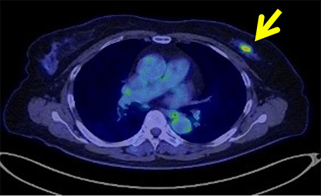 CT検査　左乳がん