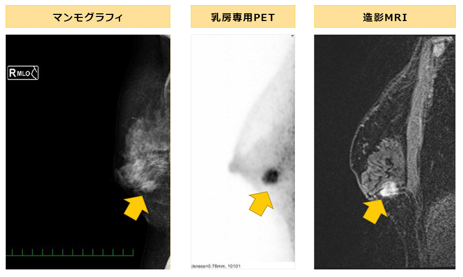 乳がん画像比較