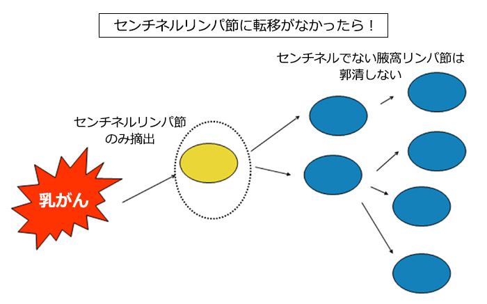 センチネルリンパ節に転移がなかったら