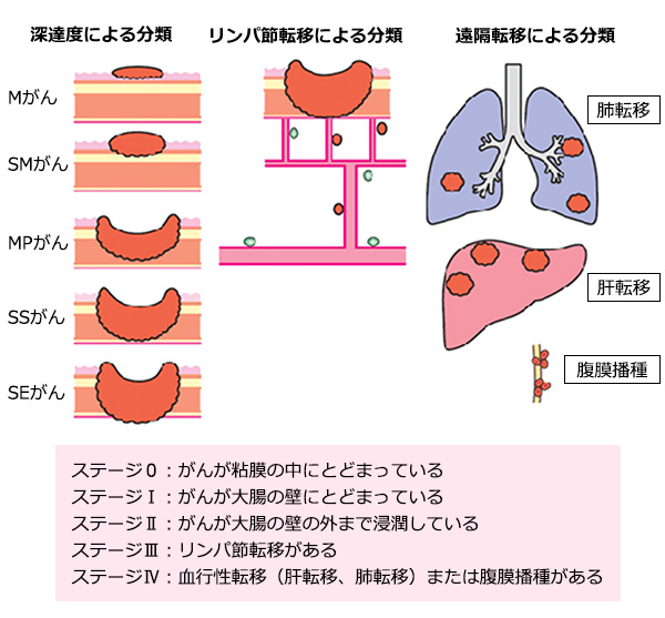 図3：大腸がんのステージと遠隔転移について