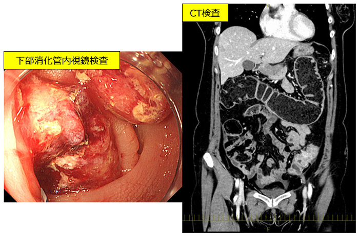 図4：大腸がんによる腸閉塞（大腸がんイレウス）の画像