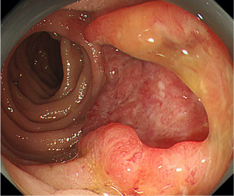 図5：大腸がんの下部消化管内視鏡検査