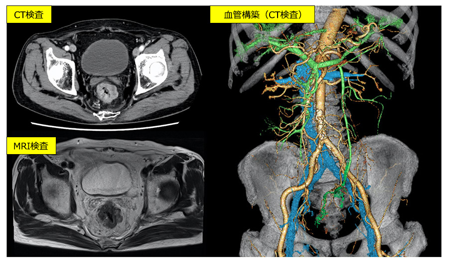 図6：大腸がんのCT、MRI検査
