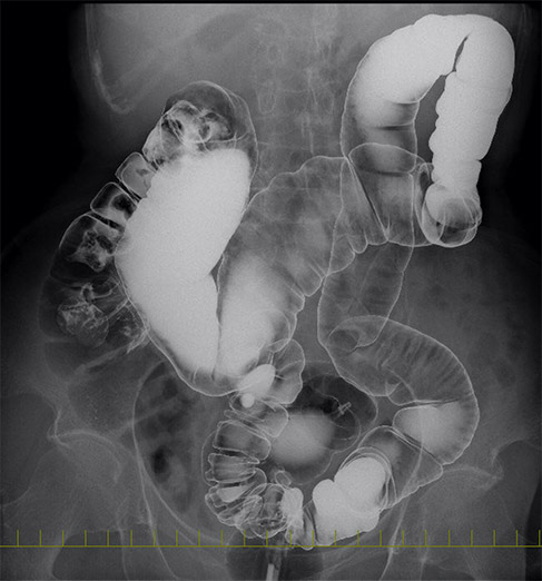 図7：注腸検査