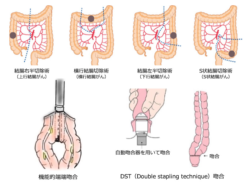 図10：結腸がんの術式、吻合について